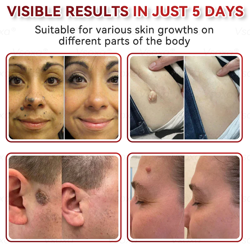 ๐ฅ 2025 New Formula โกCvreozยฎ Microneedle Skin Tag Removal Patches โ Visible Results in 5 Days