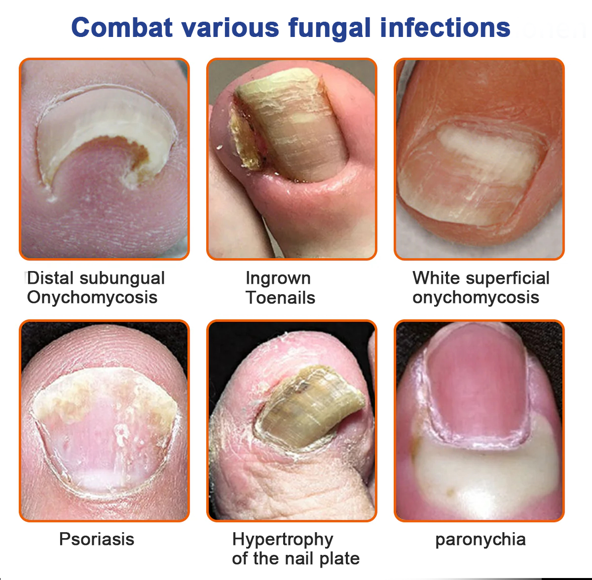 KUBOZN® Bee Venom Nail Fungus Treatment Solution👣👣