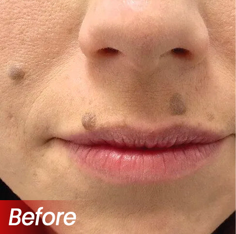 KUBOZN® Pro MicroDarts TAG'Gone Patch 20 KUBOZN® Pro MicroDarts TAG'Gone Patch