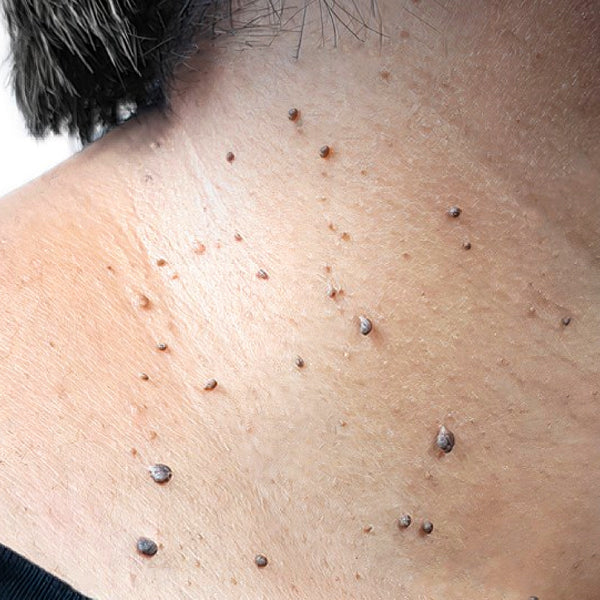 KUBOZN® Pro MicroDarts TAG'Gone Patch 17 KUBOZN® Pro MicroDarts TAG'Gone Patch