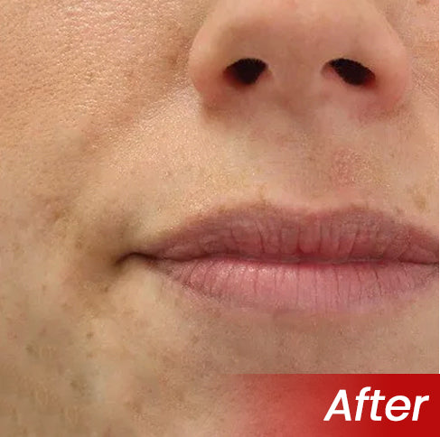 KUBOZN® Pro MicroDarts TAG'Gone Patch 19 KUBOZN® Pro MicroDarts TAG'Gone Patch