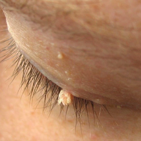 KUBOZN® Pro MicroDarts TAG'Gone Patch 18 KUBOZN® Pro MicroDarts TAG'Gone Patch