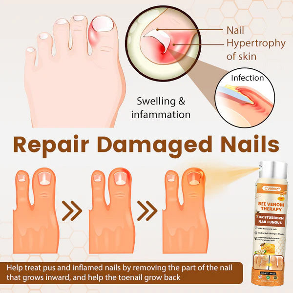 Cvreoz® Bee Venom Nail Fungus Spray (offer)