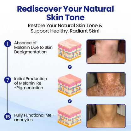Cvreoz® Vitiligo Treatment Spray (offer)