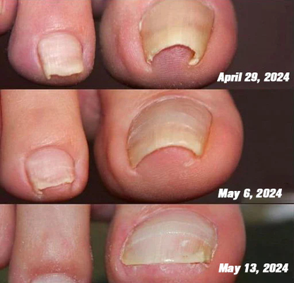 KUBOZN® Bee Venom Nail Fungus Treatment Solution👣👣