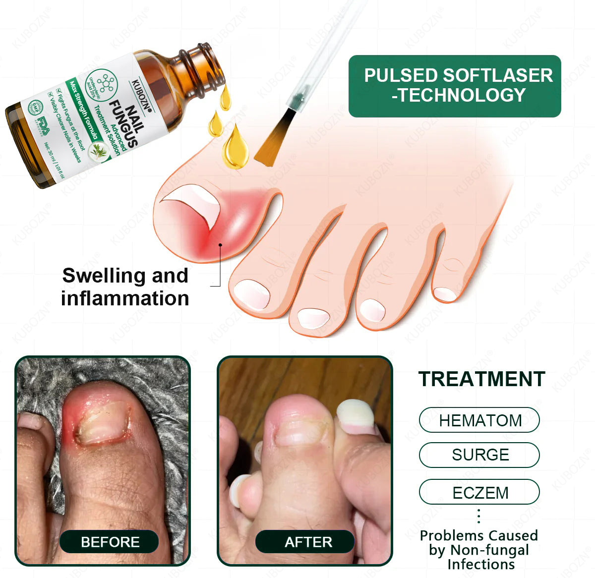 KUBOZN® Antifungal Nail Fungus Treatment Serum – Clear, Strong Nails👣