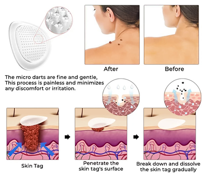 🔥 2025 New Formula- KUBOZN® Pro MicroDarts TAG'Gone Patch