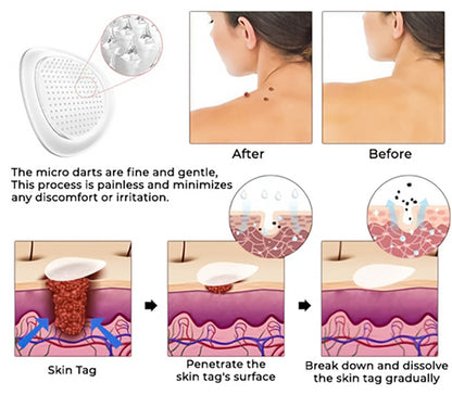 🔥 2025 New Formula- KUBOZN® Pro MicroDarts TAG'Gone Patch