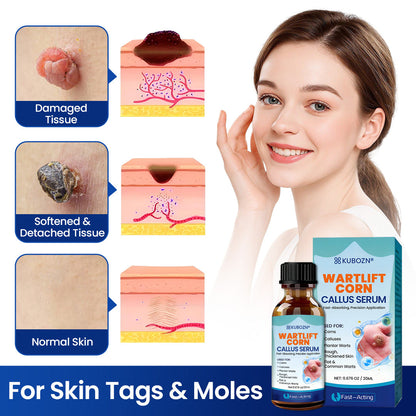 KUBOZN® WartLift Corn Removal Liquid