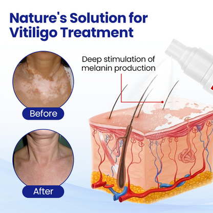 Cvreoz® Vitiligo Treatment Spray (offer)