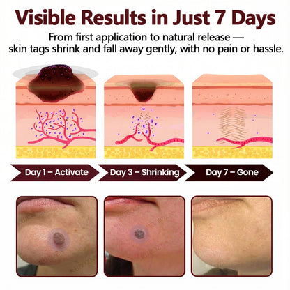 KUBOZN® OryzaDarts TAG’GONE Patch✨Pain-Free Root-Level Removal Powered by Black Rice MicroDarts. 🅱︎