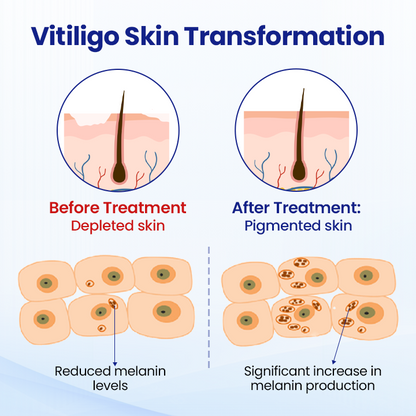 Cvreoz® Vitiligo Treatment Spray (offer)