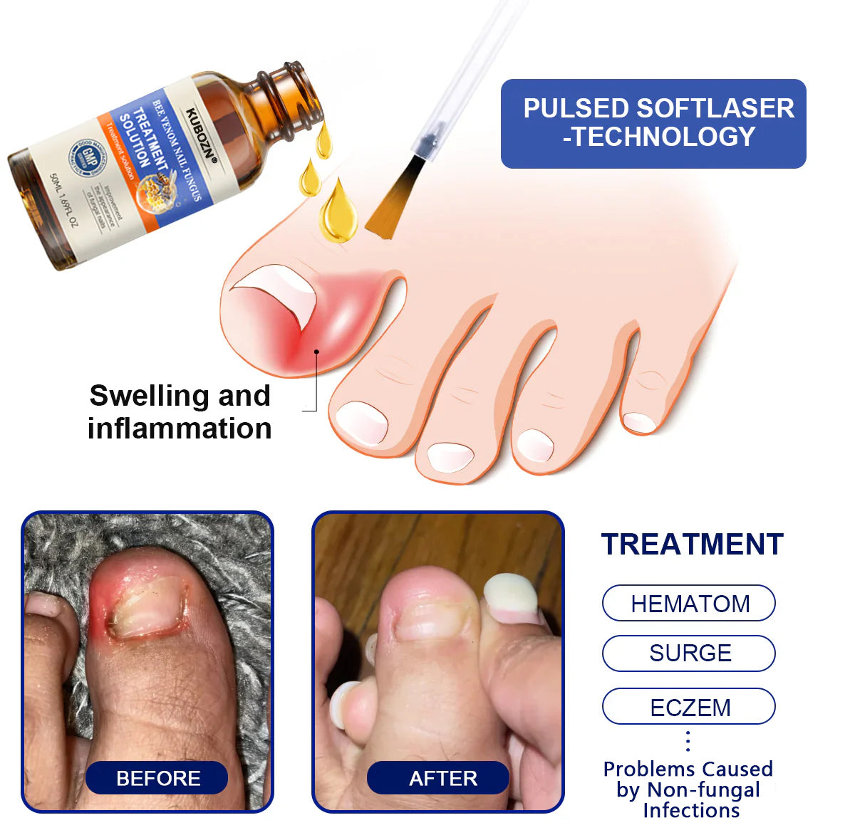 KUBOZN® Bee Venom Nail Fungus Treatment Solution👣👣